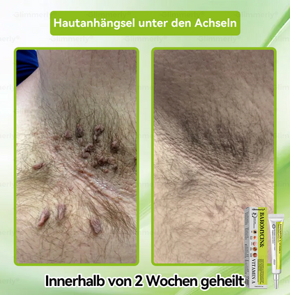 (LETZTER TAG – 40 % RABATT🔥) 💕𝗚𝗹𝗶𝗺𝗺𝗲𝗿𝗹𝘆® 𝗣𝗮𝗿𝗼𝗺𝗼𝗺𝘆𝗰𝗶𝗻 & 𝗩𝗶𝘁𝗮‑𝗔 𝗥𝗲𝘁𝗶𝗻𝗼𝗹 𝗠𝗶𝗸𝗿𝗼‑𝗜𝗻𝗳𝘂𝘀𝗶𝗼𝗻 𝗥𝗲𝗽𝗮𝗶𝗿 𝗖𝗿𝗲𝗮𝗺 (mit flüssigen Mikronadeln, formuliert zur Unterstützung der Entfernung von Warzen, Muttermalen, Altersflecken und Skin‑Tags)
