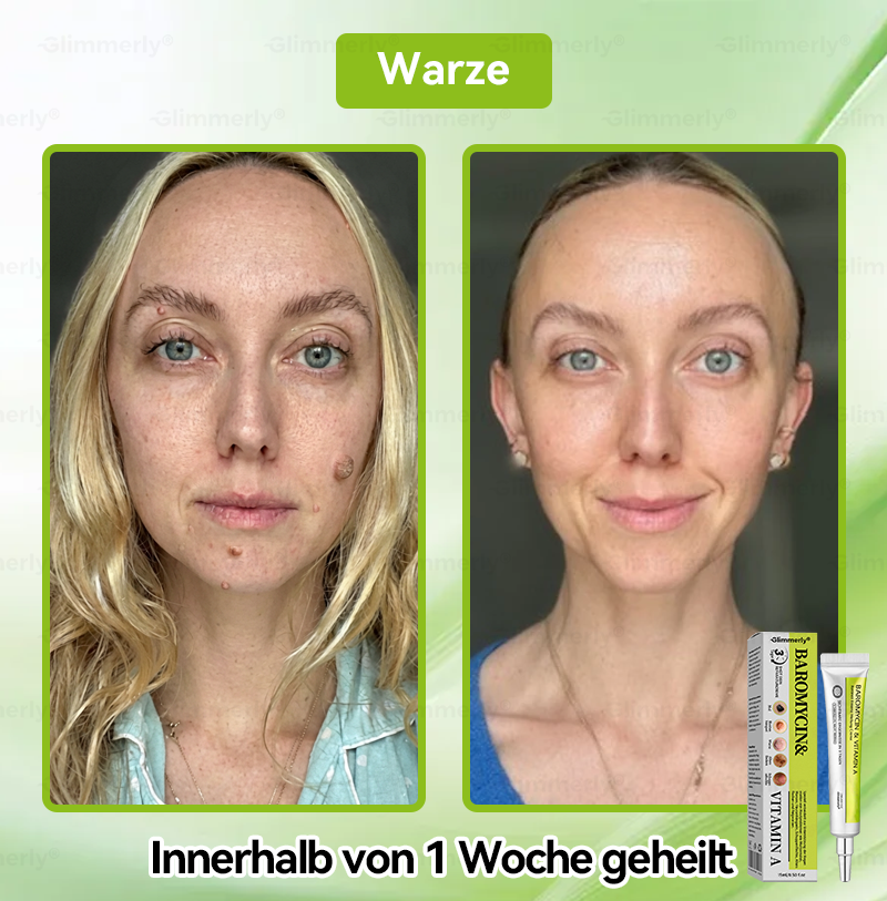 (LETZTER TAG – 40 % RABATT🔥) 💕𝗚𝗹𝗶𝗺𝗺𝗲𝗿𝗹𝘆® 𝗣𝗮𝗿𝗼𝗺𝗼𝗺𝘆𝗰𝗶𝗻 & 𝗩𝗶𝘁𝗮‑𝗔 𝗥𝗲𝘁𝗶𝗻𝗼𝗹 𝗠𝗶𝗸𝗿𝗼‑𝗜𝗻𝗳𝘂𝘀𝗶𝗼𝗻 𝗥𝗲𝗽𝗮𝗶𝗿 𝗖𝗿𝗲𝗮𝗺 (mit flüssigen Mikronadeln, formuliert zur Unterstützung der Entfernung von Warzen, Muttermalen, Altersflecken und Skin‑Tags)