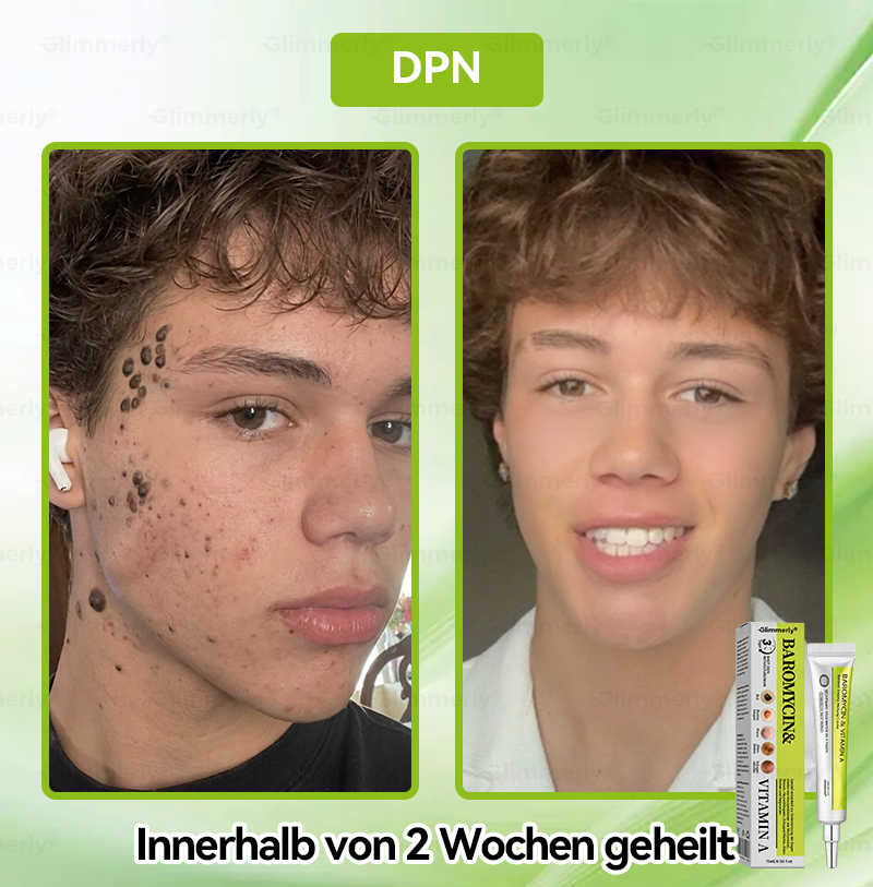 (LETZTER TAG – 40 % RABATT🔥) 💕𝗚𝗹𝗶𝗺𝗺𝗲𝗿𝗹𝘆® 𝗣𝗮𝗿𝗼𝗺𝗼𝗺𝘆𝗰𝗶𝗻 & 𝗩𝗶𝘁𝗮‑𝗔 𝗥𝗲𝘁𝗶𝗻𝗼𝗹 𝗠𝗶𝗸𝗿𝗼‑𝗜𝗻𝗳𝘂𝘀𝗶𝗼𝗻 𝗥𝗲𝗽𝗮𝗶𝗿 𝗖𝗿𝗲𝗮𝗺 (mit flüssigen Mikronadeln, formuliert zur Unterstützung der Entfernung von Warzen, Muttermalen, Altersflecken und Skin‑Tags)
