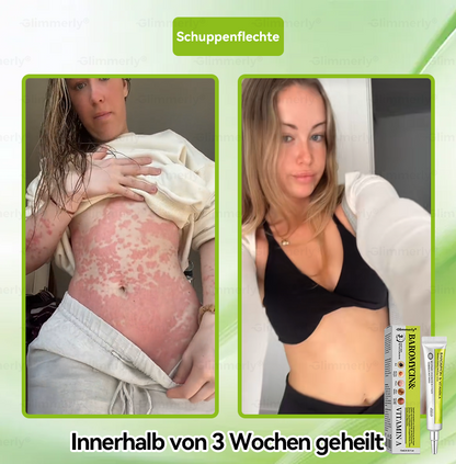 (LETZTER TAG – 40 % RABATT🔥) 💕𝗚𝗹𝗶𝗺𝗺𝗲𝗿𝗹𝘆® 𝗣𝗮𝗿𝗼𝗺𝗼𝗺𝘆𝗰𝗶𝗻 & 𝗩𝗶𝘁𝗮‑𝗔 𝗥𝗲𝘁𝗶𝗻𝗼𝗹 𝗠𝗶𝗸𝗿𝗼‑𝗜𝗻𝗳𝘂𝘀𝗶𝗼𝗻 𝗥𝗲𝗽𝗮𝗶𝗿 𝗖𝗿𝗲𝗮𝗺 (mit flüssigen Mikronadeln, formuliert zur Unterstützung der Entfernung von Warzen, Muttermalen, Altersflecken und Skin‑Tags)