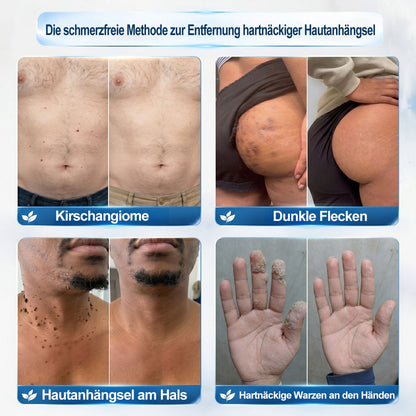 Offizieller Markenstore❄️𝑷𝑖𝒄𝐝𝐨® 7-𝑻𝒂𝒈𝒆 𝑯𝒂𝒖𝒕𝒂𝒏𝒉ä𝒏𝒈𝒔𝒆𝒍- & 𝑭𝒍𝒆𝒄𝒌𝒆𝒏𝒆𝒏𝒕𝒇𝒆𝒓𝒏𝒆𝒓(Schmerzfreier Rollerball – Keine Narbenbildung)